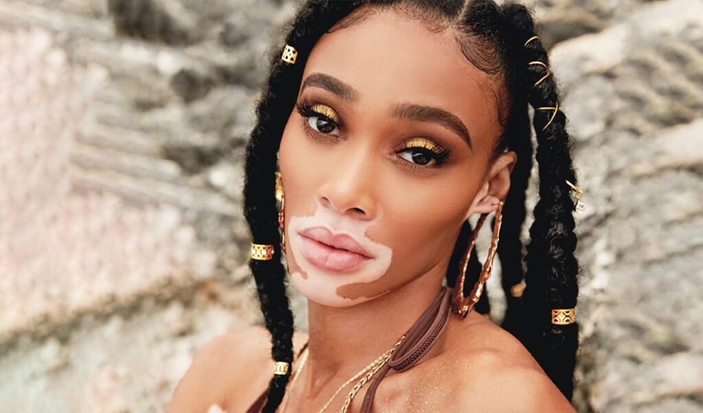 Mannequin vitiligo Winnie Harlow